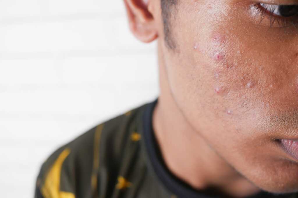 close up of young man face with skin problem